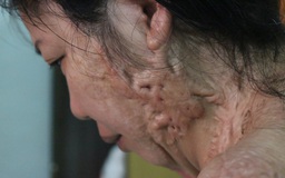 Công an Tân Bình trả lời vụ người vợ vá xe bị tạt axit ở Sài Gòn