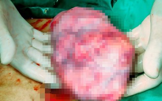Mẹ tròn con vuông sau ca mổ lấy thai, cắt khối u buồng trứng nặng 2 kg
