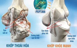 PEPTAN thiên nhiên: Giải pháp vượt trội cho bệnh xương khớp