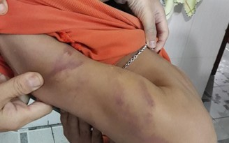 Quảng Nam: Xử phạt 1,5 triệu đồng người cha gây thương tích cho con trai