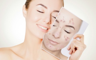 Ưu điểm của các phương pháp điều trị sẹo hiện nay Ưu điểm của các phương pháp điều trị sẹo hiện nay