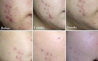 Review top 5 kem trị mụn Paula’s Choice được người dùng yêu chuộng Review top 5 kem trị mụn Paula’s Choice được người dùng yêu chuộng