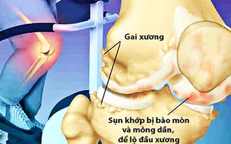Xương 'mọc' gai: Vì đâu nên nỗi?