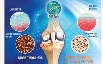 Điều trị bệnh xương khớp: Hiệu quả cần đi đôi với an toàn!