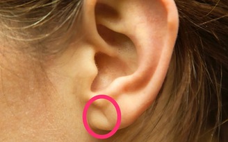 Thấy nếp gấp này trên tai có thể là dấu hiệu bệnh tim mạch
