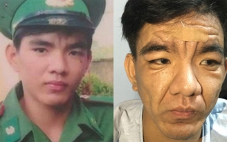 Chàng trai 23 tuổi hóa... 'ông lão' nói gì về khuôn mặt biến dạng?