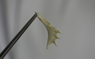 Bác sĩ “choáng” với xương cá hình chân con vịt trong thực quản bệnh nhi