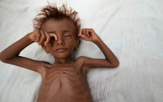 Nội chiến Yemen làm hơn 80.000 trẻ em chết đói