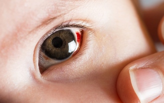 Châu Âu ghi nhận virus gây xuất huyết ở mắt, tỷ lệ tử vong đến 40%