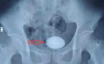 Hy hữu: Quên ống thông 5 năm trong niệu quản, sỏi bàng quang to như trứng ngỗng