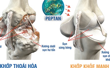 Phục hồi xương dưới sụn: Bước đột phá trong kiểm soát thoái hóa khớp