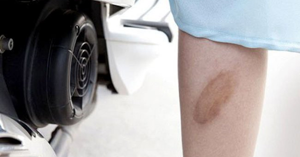 Bị bỏng bô xe máy nên lưu ý những gì để không bị sẹo?