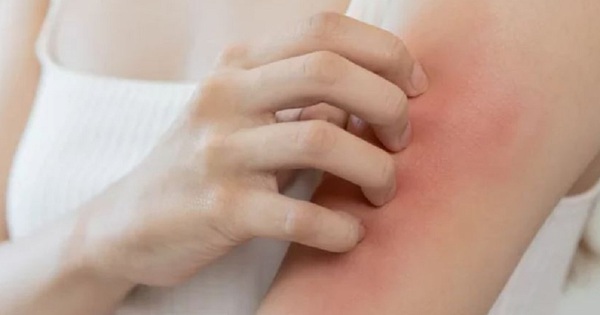 Phải làm gì khi nghi ngờ bị dị ứng thuốc?