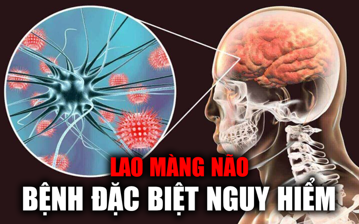 Bé gái 2 tháng tuổi bị lao màng não: Không chẩn đoán được bệnh, biến chứng đầu to