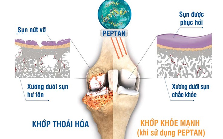 Chữa bệnh xương khớp - Cẩn trọng trước các “thần dược” thiếu nghiên cứu khoa học