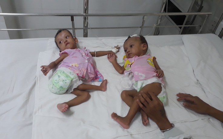 Phẫu thuật tách rời 2 bé gái dính lưng hiếm gặp trên thế giới