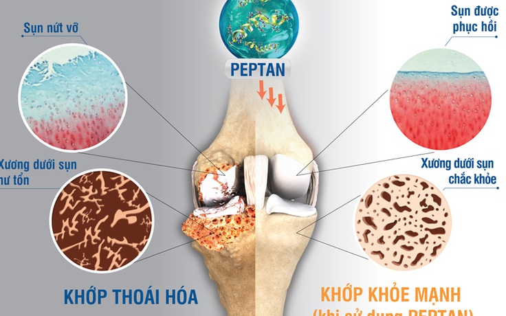 Những khó khăn trong điều trị bệnh xương khớp