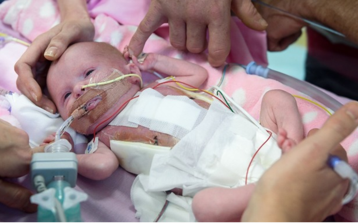 Cứu sống bé sơ sinh đầu tiên tại Anh có tim ngoài lồng ngực