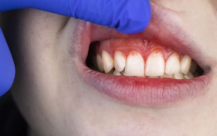 Làm sao để phân biệt đau là do răng hay nướu? Làm sao để phân biệt đau là do răng hay nướu?