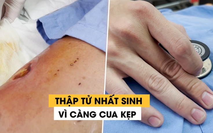 Suýt chết vì bị cua kẹp rồi tự ý đắp thuốc nam