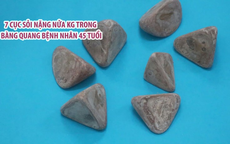 Mổ lấy 7 cục sỏi nặng nửa kg trong bàng quang bệnh nhân nam 45 tuổi