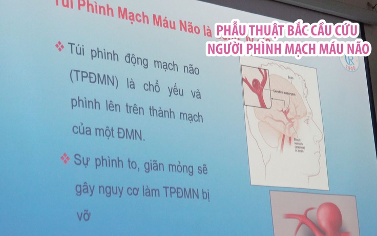 Phẫu thuật bắc cầu cứu sống bệnh nhân bị phình mạch máu não