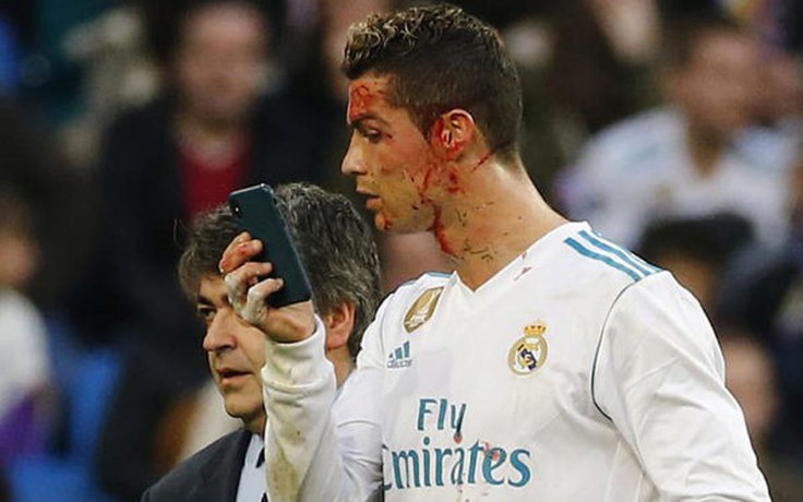 Dũng cảm ghi bàn, Ronaldo phải ôm mặt máu rời sân