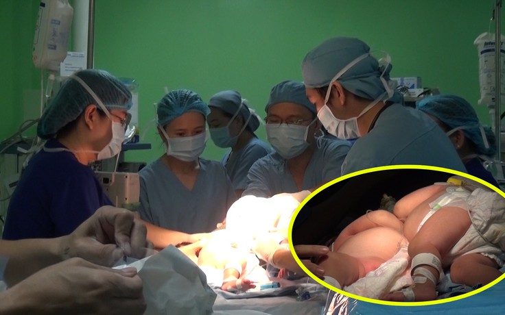 Phẫu thuật thành công 2 bé gái song sinh dính liền nhau