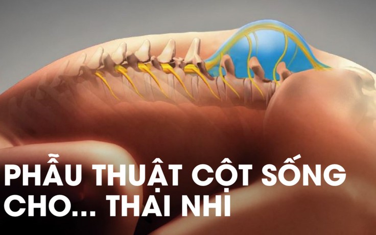 Phẫu thuật nội soi trong bụng mẹ cứu thai nhi bị nứt đốt sống