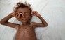 Nội chiến Yemen làm hơn 80.000 trẻ em chết đói