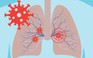 Omicron ảnh hưởng ít nghiêm trọng đến phổi hơn các biến thể Covid-19 trước