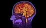 Lú lẫn, 'sương mù não' hậu Covid-19: có biến đổi ở não giống bệnh Alzheimer?