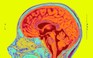 Nghiên cứu: Covid-19 có thể gây 'teo não'